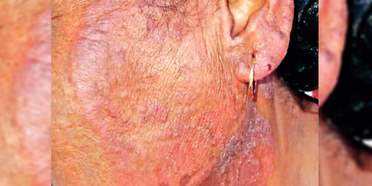 ටීනියා රෝගීන් ගැන භයානක අනාවරණයක්